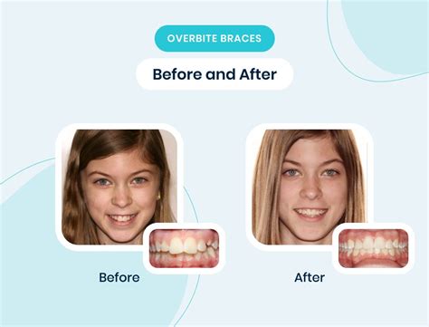 A Complete Guide To Overbite Braces