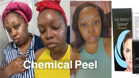 Chemical Peel The Perfect Derma Before And After Youtube