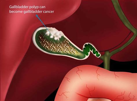 Gallbladder Polyps Definition Causes Symptoms Diagnosis Treatment