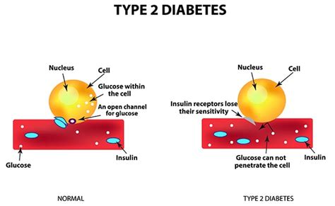 Position statement of the american diabetes association (ada) and the european association for the study of diabetes. What is Diabetes | Diabetes Mellitus: Types, Symptoms ...