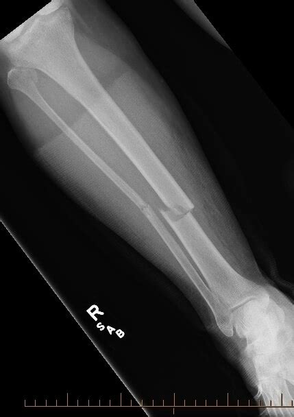 Broken Tibia Tibial Shaft Fracture Diagnosis And Treatments Roc