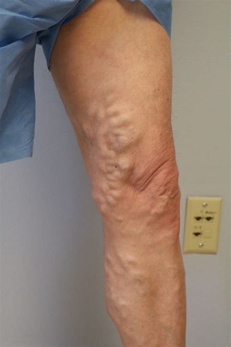 Varicose Veins Before And After Pictures And Images Surgery And Treatment