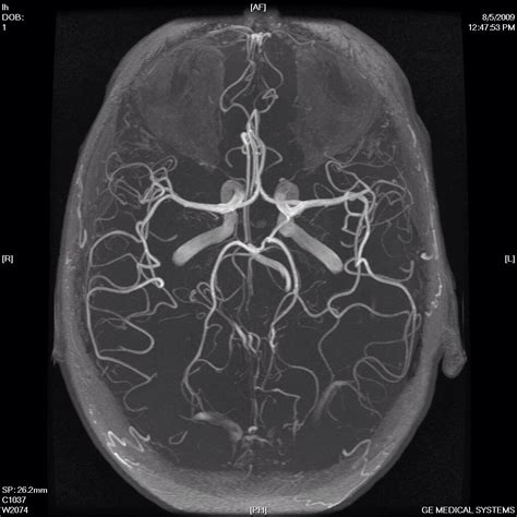 Círculo De Willis Radiología Imagenologia Neurociencia