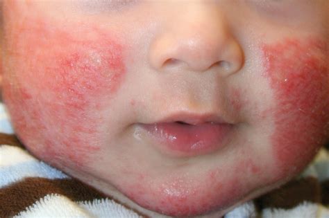Красота и медицина электронный ресурс // дата дострупа: Atopic Dermatitis - Home Remedies, Pictures, Treatment ...