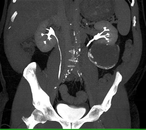 Cystic Renal Cell Carcinoma Kidney Case Studies Ctisus Ct Scanning