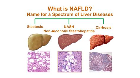 What Is Non Alcoholic Fatty Liver Disease Nafld Youtube