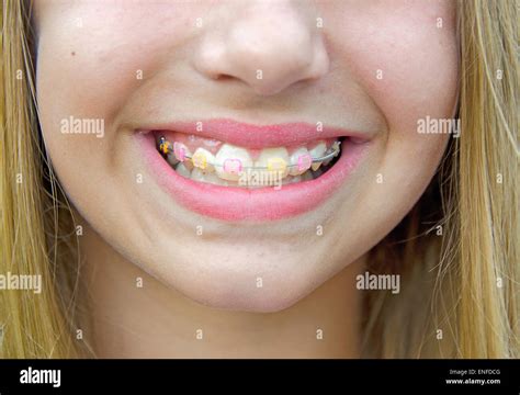 Orthodontic Braces On Teeth Banque De Photographies Et Dimages Haute