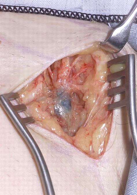 Surgical Management Of Metastatic Inguinal Lymphadenopathy The Bmj