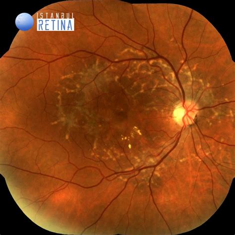 54 Choroidal Neovascular Membrane Secondary To Pattern Dystrophy