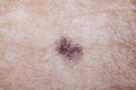 Melanoma Therapies And The Skin Dermatology Times