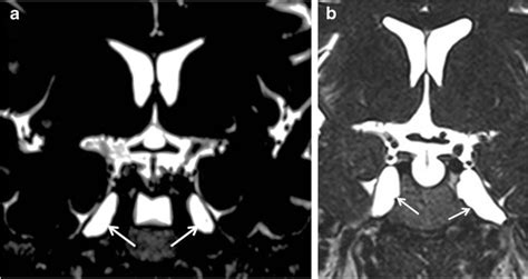 A And B T2w Coronal Mr Images Show Meckels Cave Enlargement Without