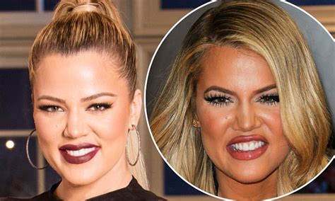 Khloe Kardashian Admits Her Facial Fillers Went Wrong And Made Her Look