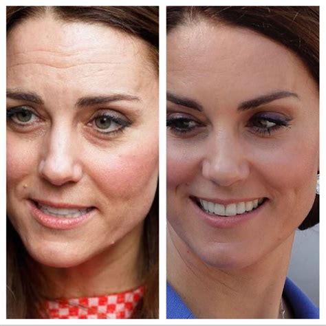 Έκανε Botox η Kate Middleton Elle
