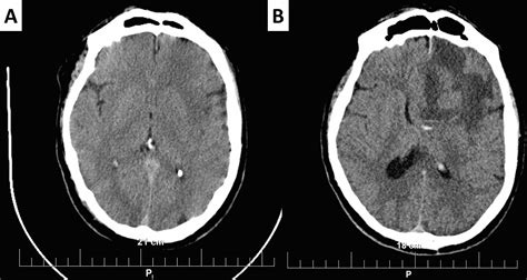 Cureus The Rapid Development Of Glioblastoma A Report Of Two Cases