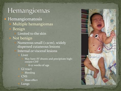 Ppt Hemangiomas And Vascular Malformations Powerpoint Presentation