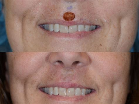 Squamous Cell Of Lip Reconstructed Following Mohs Surgery