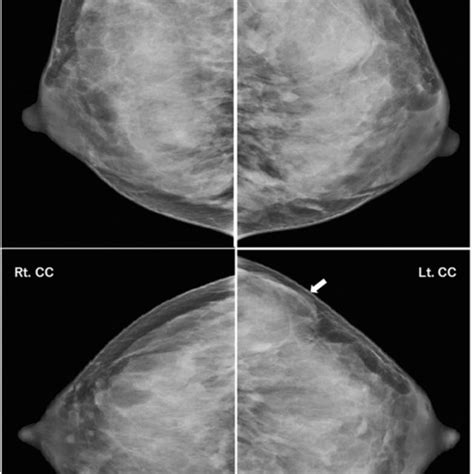 Mammogram Showing An Equal Density Lobular Mass Indicated By The Arrows Download Scientific