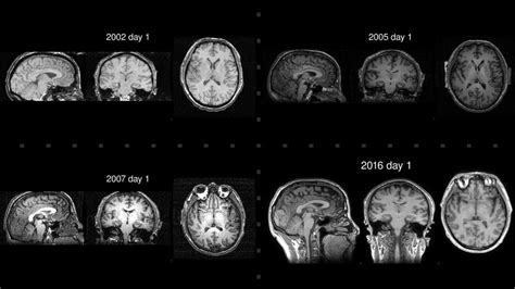 Brain Scans Link Meditation To Slower Brain Aging In Advanced
