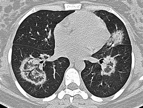 Interstitial Pneumonia Lung Ct Scan Stock Image C0384551