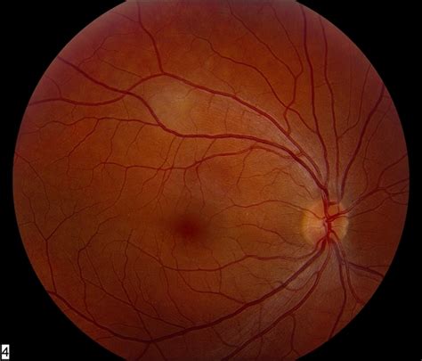 Unilateral Acute Idiopathic Maculopathy Color Photo Retina Image Bank