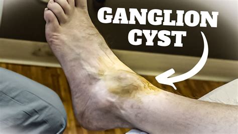 Aspiration Of A Ganglion Cyst Procedure And Recovery Time Does It Hurt