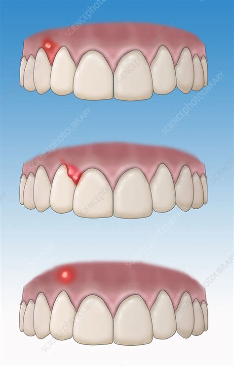 Types Of Dental Abscesses Illustration Stock Image C0366293