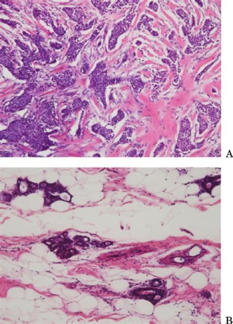 Metachronous Bilateral Ectopic Breast Carcinoma In The Axilla A Case