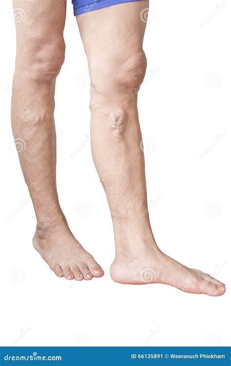 Irregular Varicose Veins On Woman Legs Stock Image Image Of Body
