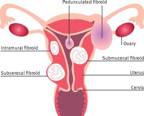 Fibroids Diagnosis And Management The Bmj