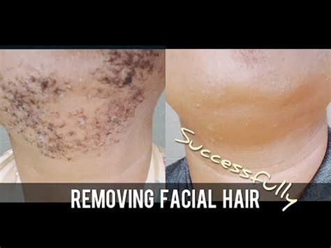 Removing white facial hairs requires the same techniques you used when taking off darker hairs on your face. Chin hair - BEST FACIAL HAIR REMOVAL: avoid razor bumps ...