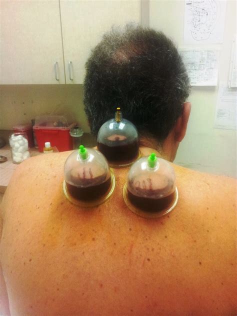 Hijama Aka Wet Cupping The Treatment Of Choice Delivered By Dr Tsan