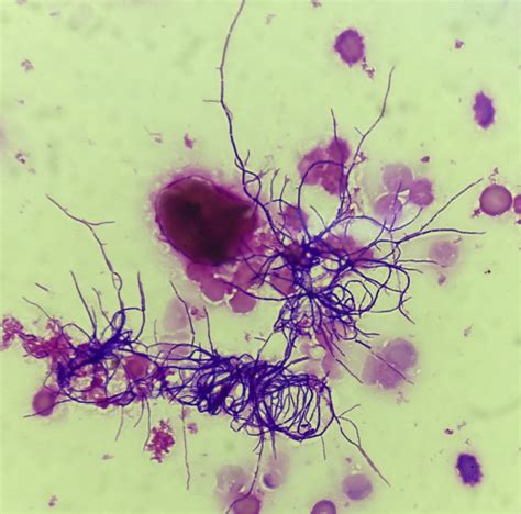Disseminated Nocardiosis With Nocardia Brasiliensis Bacteremia In A