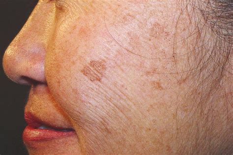 What are the black spots on my orange cat's lips and nose? Best In-Office Treatments to Target Dark Spots: Orange ...