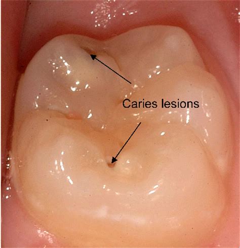 Caries Lesions On The Occlusal Surface Of Molar Tooth Download