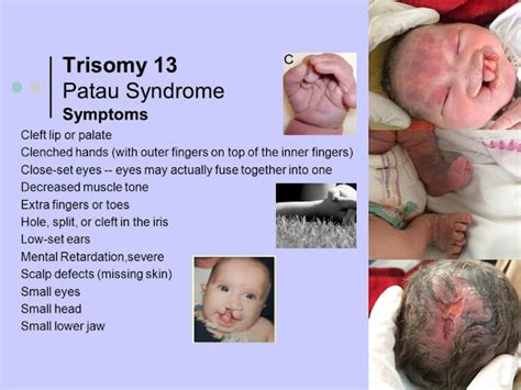 Patau Syndrome A K A Trisomy 13