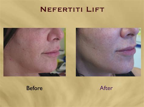 Aesthetics Hawaiinefertiti Lift And Neck Wrinkle Smoothing With Botox