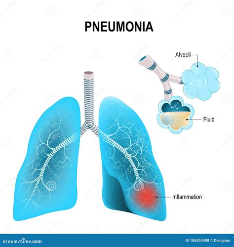 Pneumonia Human Lungs And Inflamed Alveoli Stock Vector