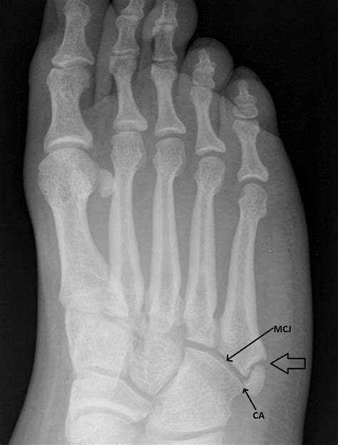 Oblique View Of A Foot Series Demonstrating A Minimally Displaced