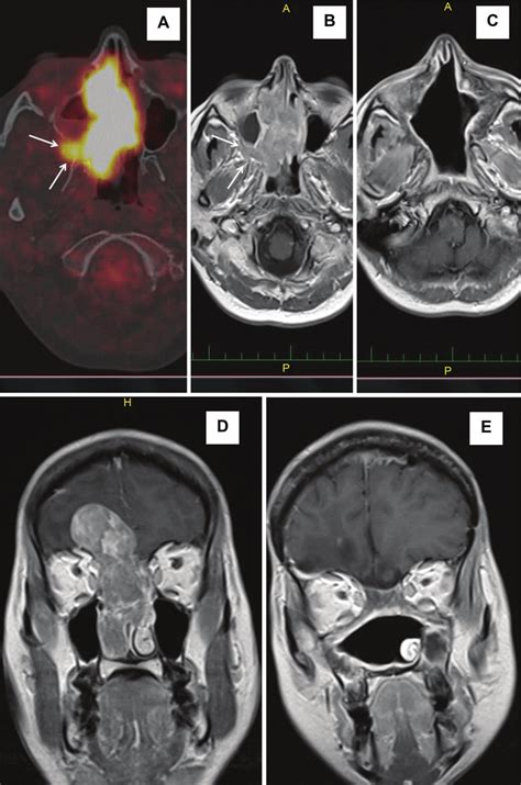 Sinonasal Undifferentiated Carcinoma T B Case P Axial Pet Ct A