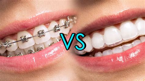 Metallic Braces Vs Invisalign Braces Whats Best Regent Dental Uk