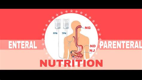 Nutritional Support Enteral And Parenteral Nutrition 22 Youtube