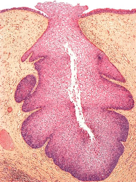 Inverted Nasal Papilloma Stock Image C019 9251 Science Photo Library