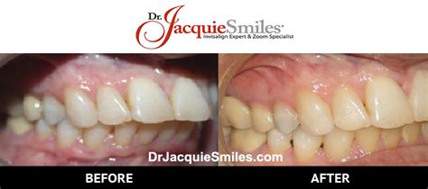 Invisalign Before And After Photos Of Nyc Patientsdr Jacquie