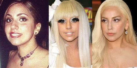 Lady Gaga Plastic Surgery Before And After Pictures 2018
