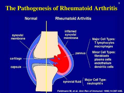 Pathogenesis Of Rheumatoid Arthritis Novel Drug Delivery Systems For