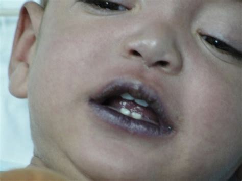 Central cyanosis is associated with arterial desaturation and involves the skin, mucous membranes, lips, tongue, and nail beds. Purple Lips May Be More Serious Than You Think It Is