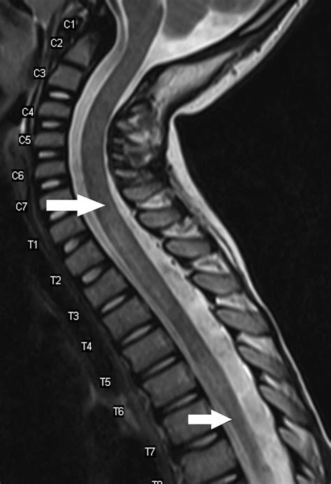 Transverse myelitis is an inflammatory disorder of the spinal cord leading to loss of muscle power, sensory symptoms (pins and needles) and bladder and bowel dysfunction. T2 weighted sagittal MRI spine shows long segment ...