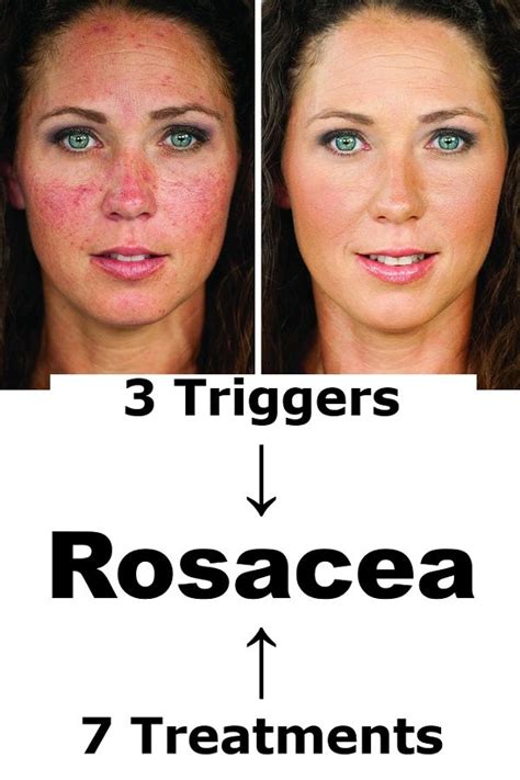 Rosacea → 3 Triggers And 6 Natural Treatments At Home