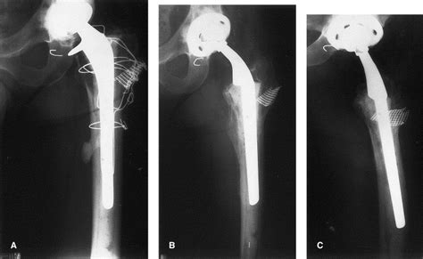 Long Stem Cemented Calcar Replacement Arthroplasty For Proximal Femoral
