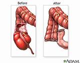 Sigmoid Colon Removal Recovery Pictures